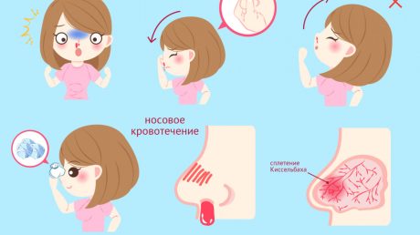 Как остановить кровотечение из носа