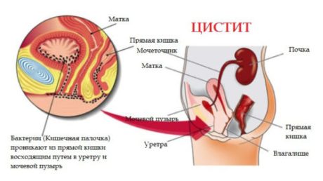 Как проходит цистит во время месячных