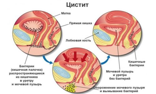 Как проявляется воспаление мочевого пузыря у женщин?