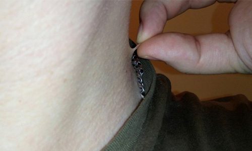 Как удалить висячую папиллому в домашних условиях?
