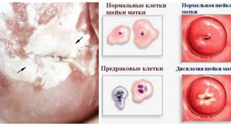 Как влияет дисплазия шейки матки на беременность?