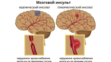 Как восстановить потенцию мужчине после инсульта?