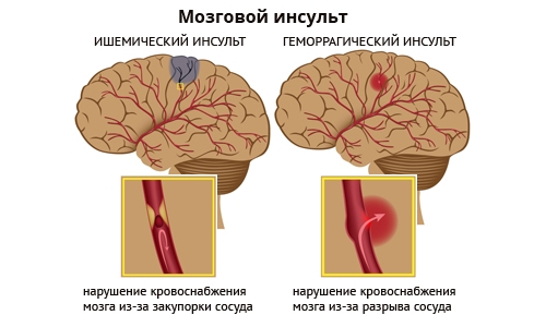 Как восстановить потенцию мужчине после инсульта?