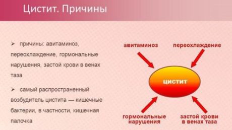 Каковы причины цистита у женщин?