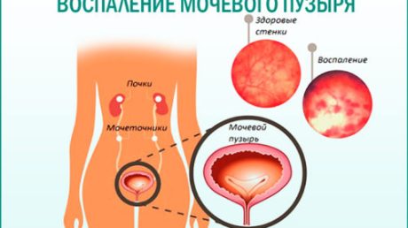 Какой антибиотик принимают при цистите однократно?