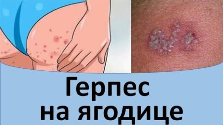 Лечение герпеса на копчике и ягодицах