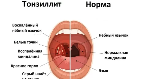 Лечение хронического тонзиллита травяными средствами