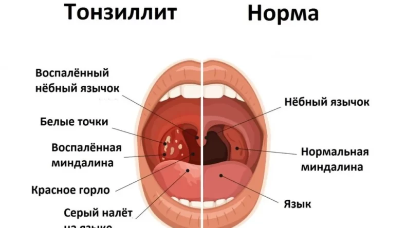 Лечение хронического тонзиллита травяными средствами