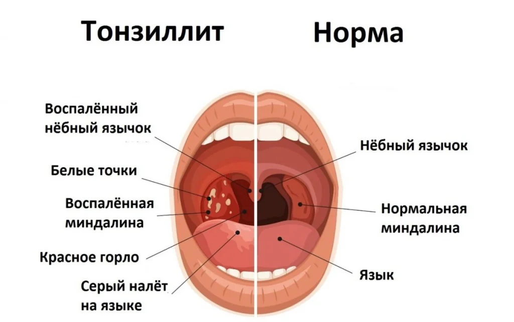 Лечение хронического тонзиллита травяными средствами