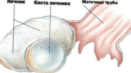 Лечение и профилактика серозных кист яичника