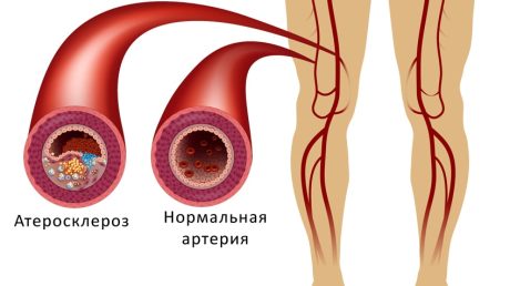 Магнитотерапевтические методы лечения атеросклероза