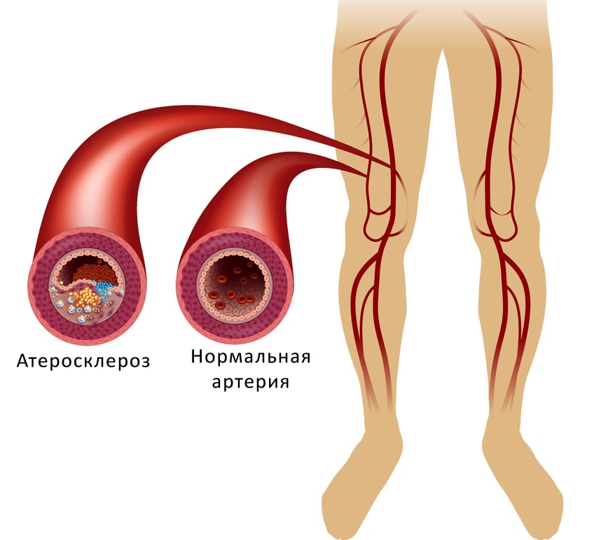 Магнитотерапевтические методы лечения атеросклероза