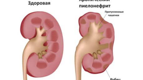 Методы лечения цистита с кровью у женщин