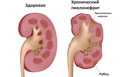Методы лечения цистита с кровью у женщин