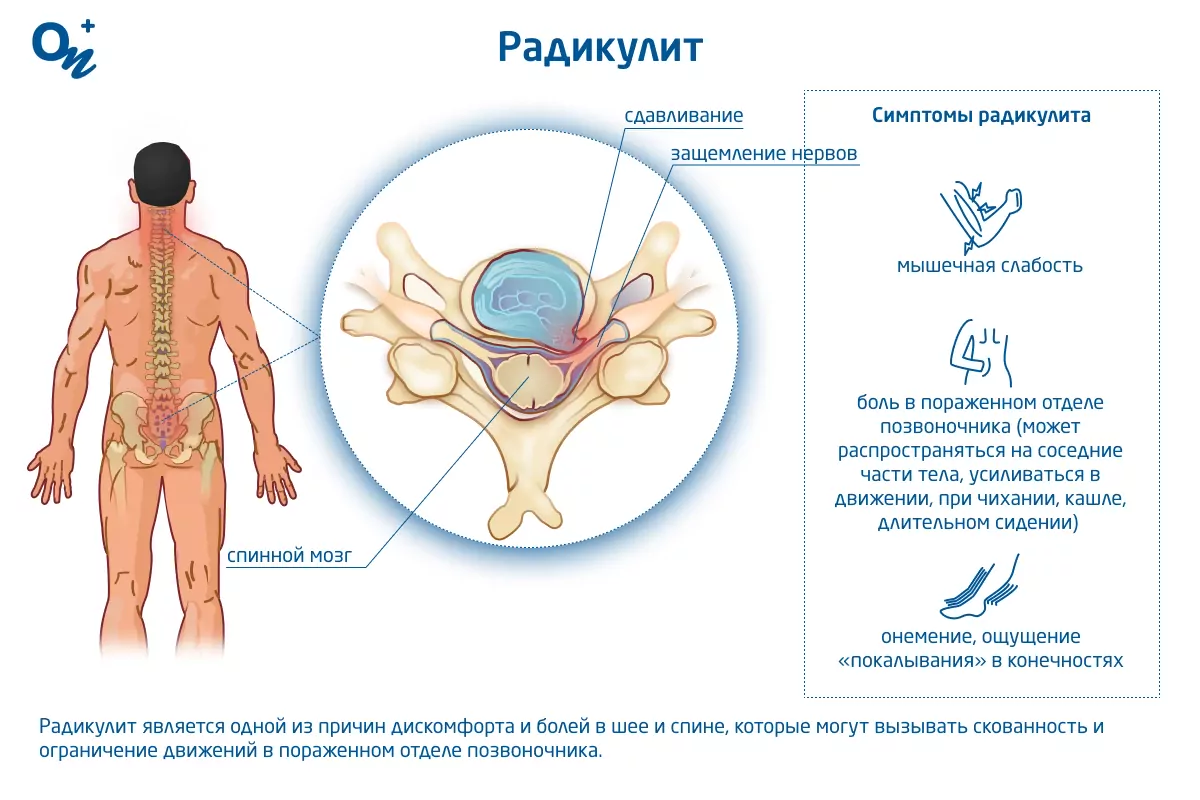 Минералы в терапии радикулита