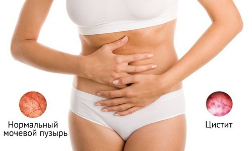 Может ли цистит пройти сам, если его не лечить?