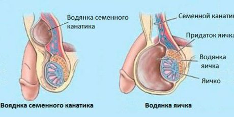 Можно ли лечить водянку яичка у мужчин без операции?