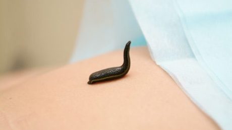 Можно ли вылечить эндометрит у женщин пиявками?