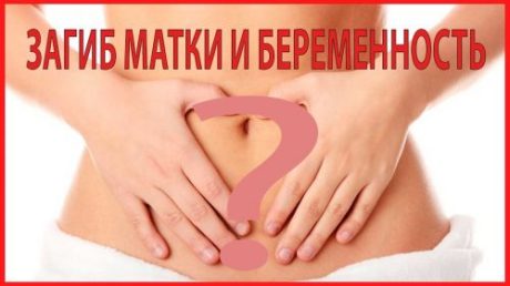 Можно ли забеременеть при загибе матки у женщины?