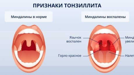 Терапия ангины: народные средства и другие способы лечения