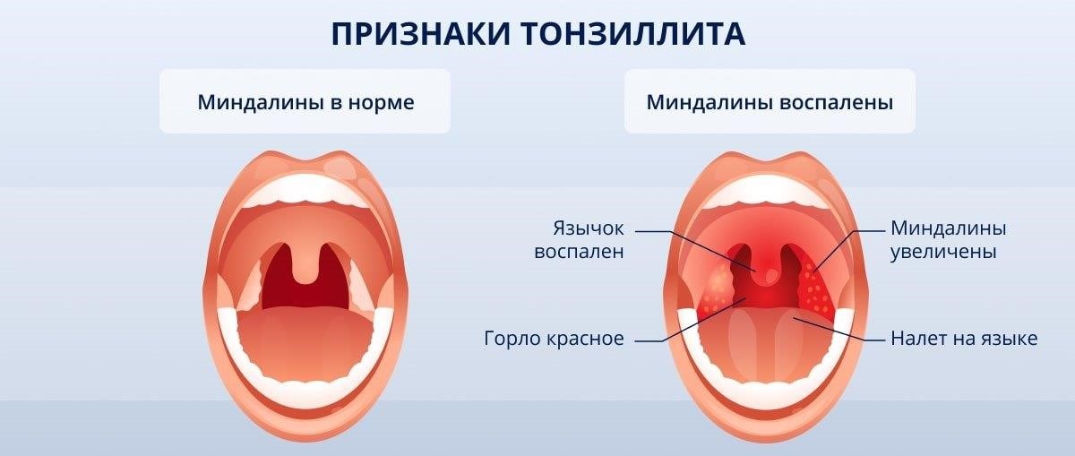 Терапия ангины: народные средства и другие способы лечения