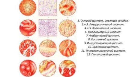 Наиболее эффективные лекарства от цистита для детей