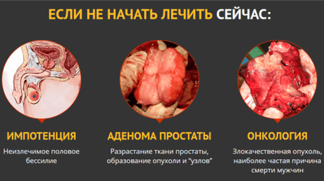 Обзор недорогих и эффективных свечей от аденомы простаты