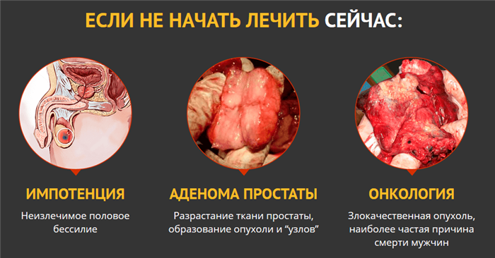 Обзор недорогих и эффективных свечей от аденомы простаты