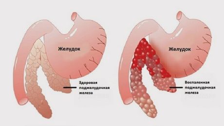 Острый панкреатит: диагностика, признаки, осложнения