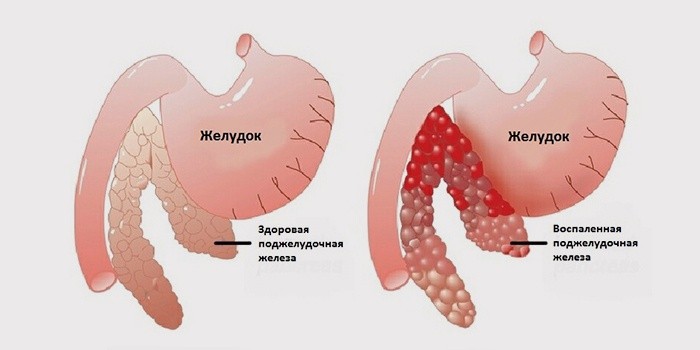Острый панкреатит: диагностика, признаки, осложнения