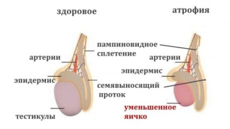 Почему возникает атрофия яичек и как можно этого избежать?