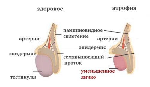 Почему возникает атрофия яичек и как можно этого избежать?