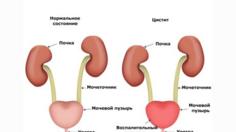 Почему возникает и как проявляется обострение хронического цистита