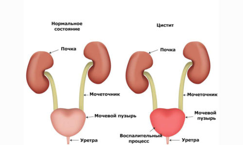 Почему возникает и как проявляется обострение хронического цистита
