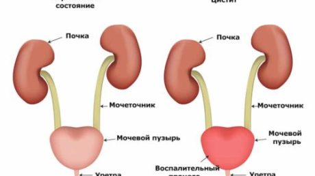 Почему возникает тошнота и рвота при цистите