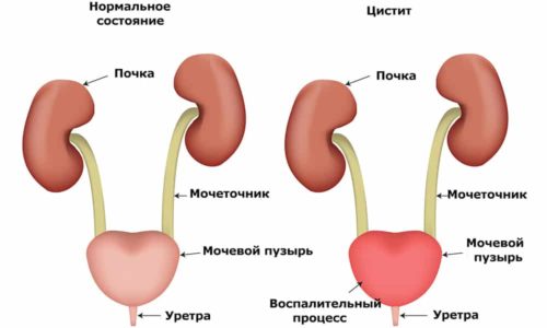 Почему возникает тошнота и рвота при цистите
