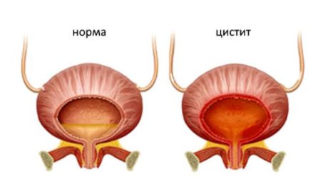 Почему возникает цистит после кесарева сечения?