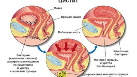 Причины и лечение цистита в пожилом возрасте