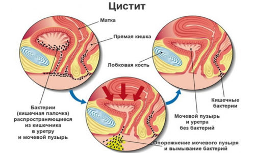Причины и лечение цистита в пожилом возрасте