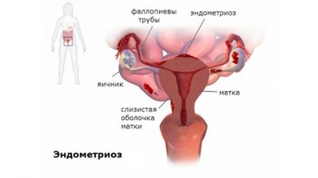 Применение Линдинета 20 и 30 для лечения эндометриоза