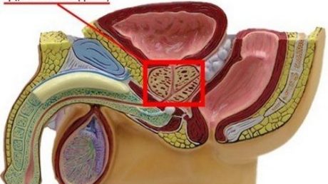 Признаки диффузных изменений простаты и их лечение