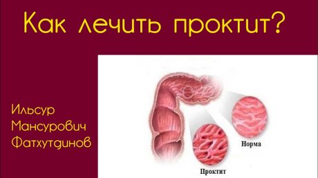 Проктит: Традиционные методы терапии и другие способы народной помощи.