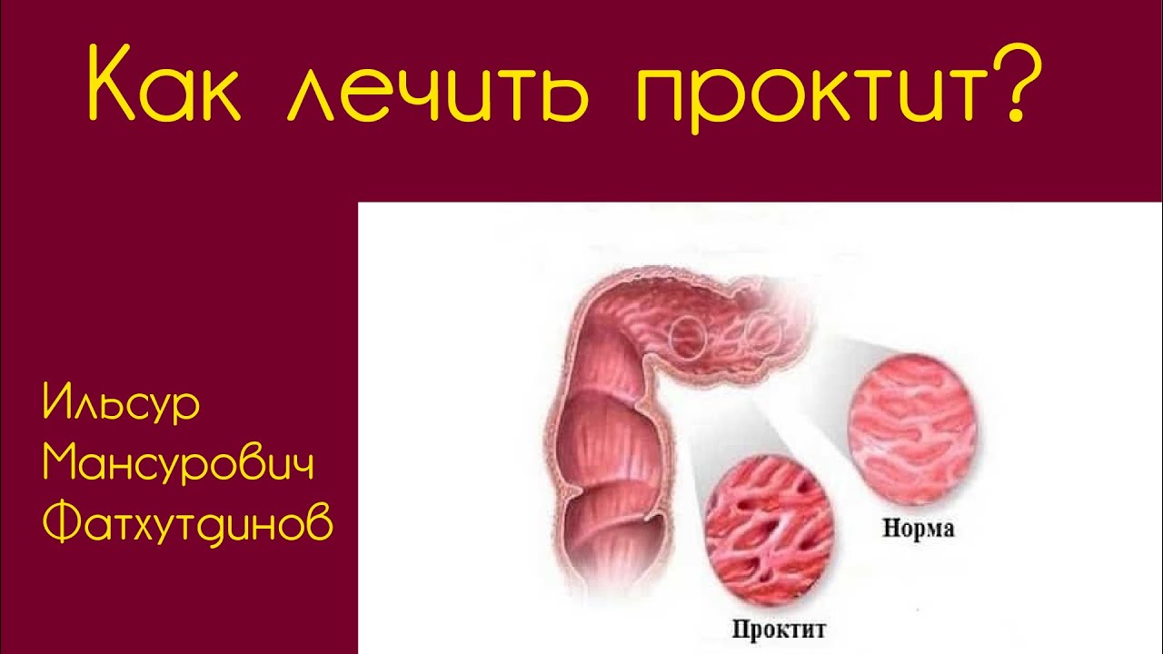 Проктит: Традиционные методы терапии и другие способы народной помощи.