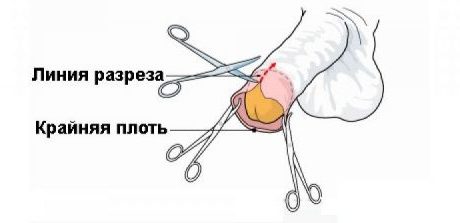 Процедура обрезания крайней плоти у мальчиков