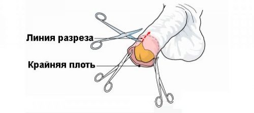 Процедура обрезания крайней плоти у мальчиков