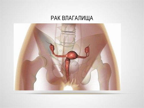 Проявление рака влагалища и методы его лечения
