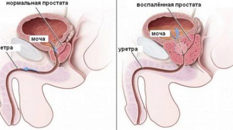 Рецепты использования каштана для лечения простатита