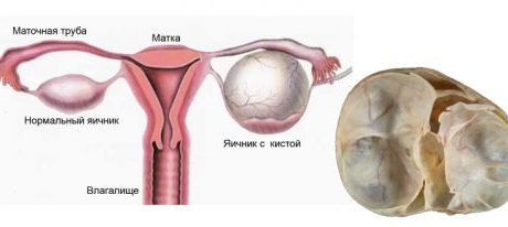 Симптомы многокамерной кисты яичника и ее лечение