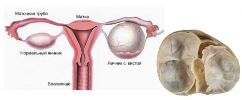 Симптомы многокамерной кисты яичника и ее лечение