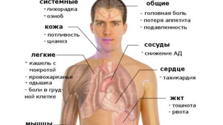 Скрытая или бессимптомная пневмония – как распознать опасное заболевание
